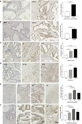 IL-38 promotes the development of prostate cancer